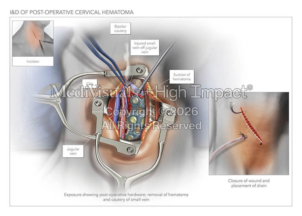 I&D of Post-Operative Cervical Hematoma