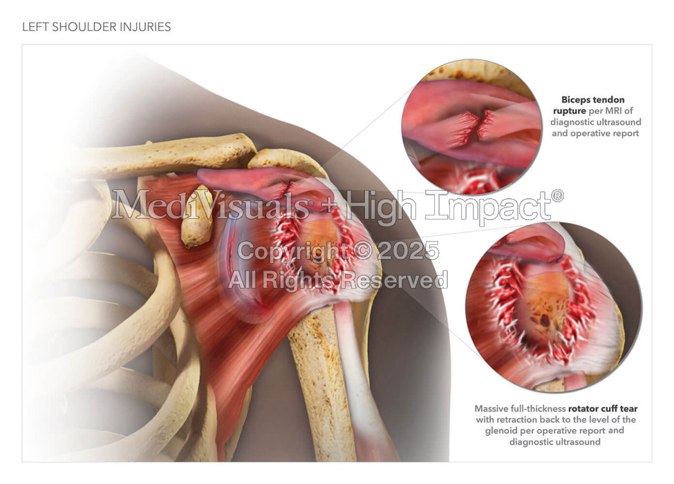 Left Shoulder Injuries