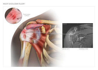 Right Shoulder Injury