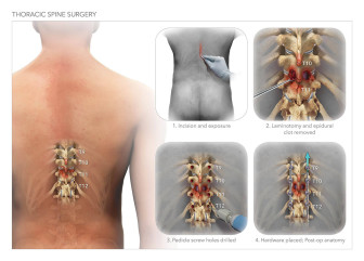 Thoracic Spine Surgery