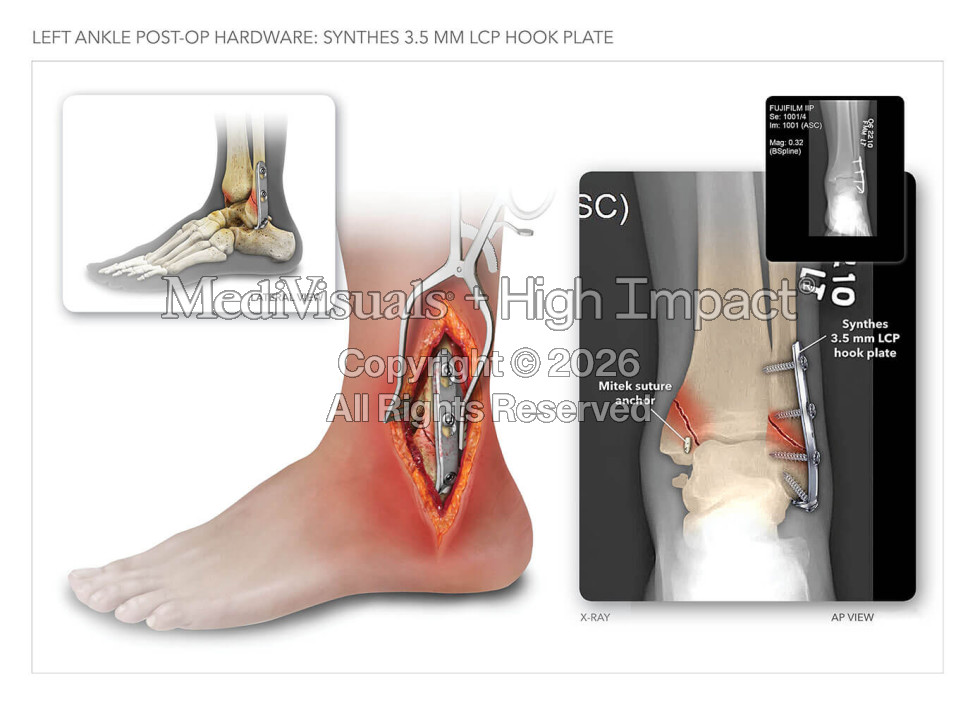 Left Ankle Post-Op Hardware