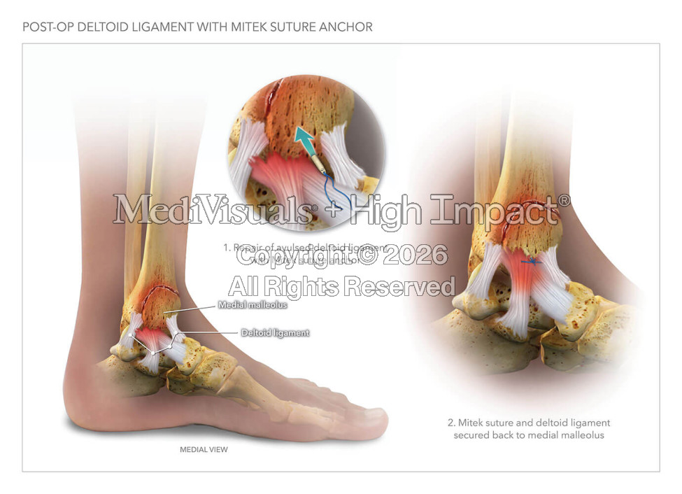 Post-Op Deltoid Ligament with Mitek Suture Anchor