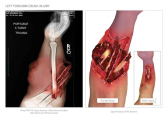 Forearm Fracture Illustration