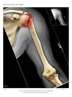 X-Ray of the Left Arm