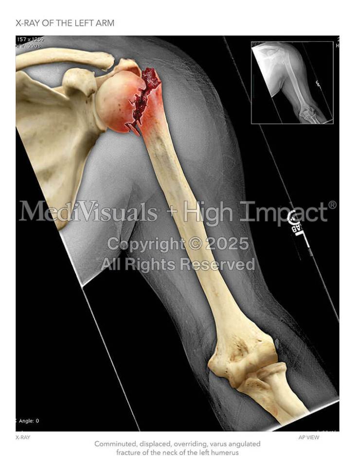 X-Ray of the Left Arm