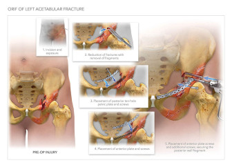 ORIF of Left Acetabular Fracture