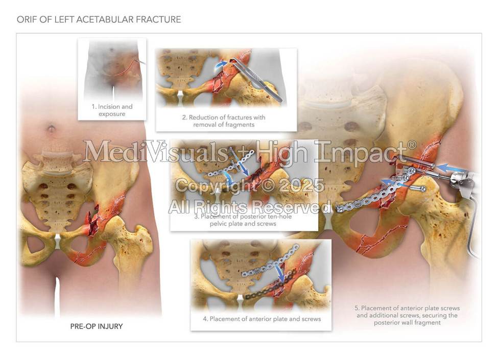 ORIF of Left Acetabular Fracture