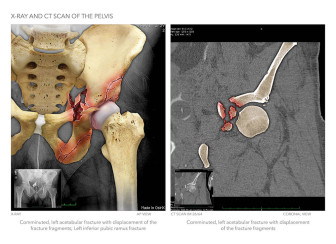 X-Ray and CT Scan Showing Complex Pelvic Injuries