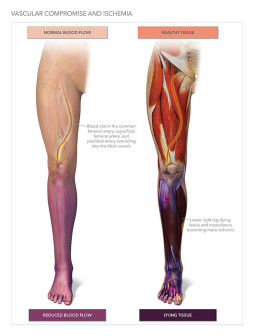 Leg Ischemia with Amputation