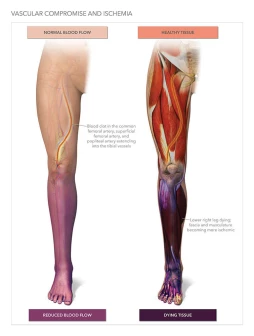 Leg Ischemia with Amputation