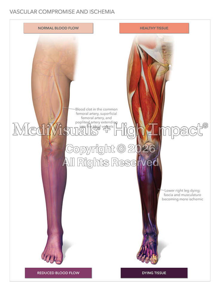 Leg Ischemia with Amputation