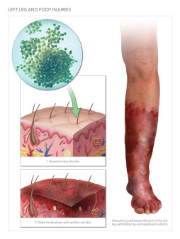 Left Leg and Foot Injuries