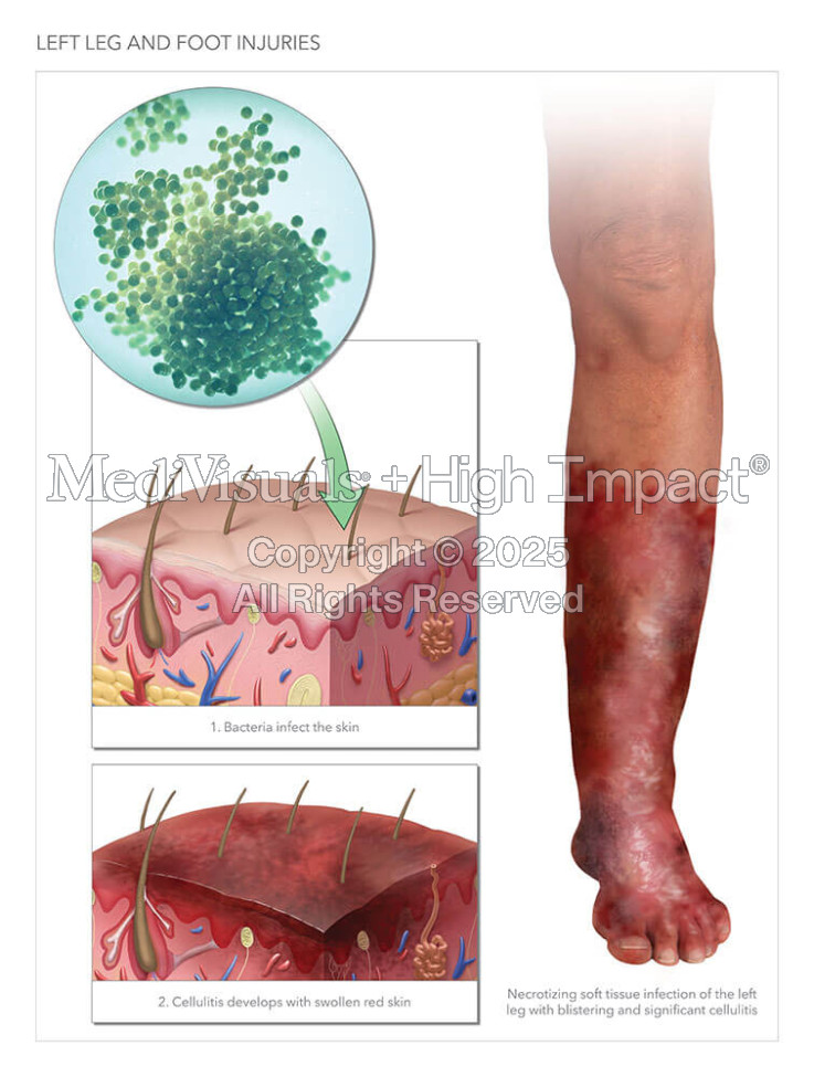 Left Leg and Foot Injuries