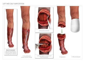 Mid-Calf Amputation