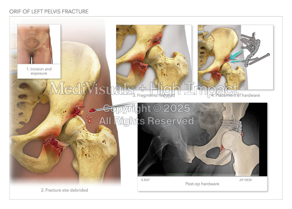 ORIF of Left Pelvis Fracture