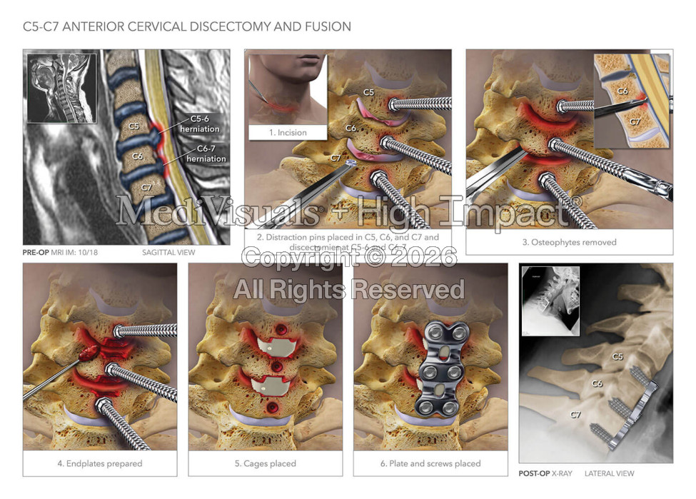 C5-7 Anterior Cervical Discectomy and Fusion
