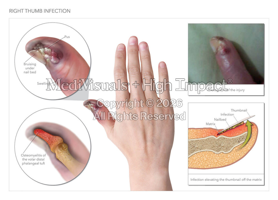Thumb Infection and Treatment
