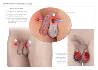 Summary of Gunshot Injuries