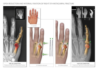 ORIF of Metacarpal Fracture