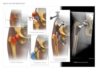 Right Hip Arthroplasty