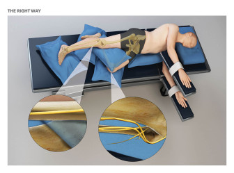 Mechanism of Vascular Injuries