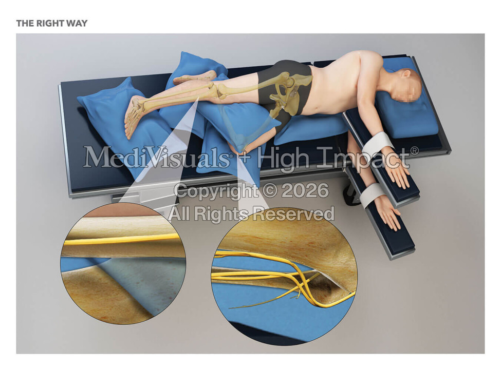 Mechanism of Vascular Injuries