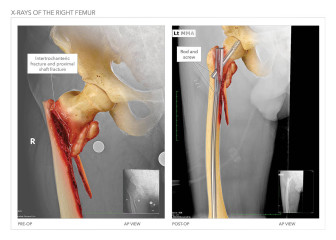 X-Rays of the Right Femur