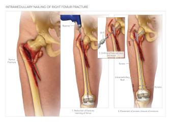 Intramedullary Nailing of Right Femur Fracture