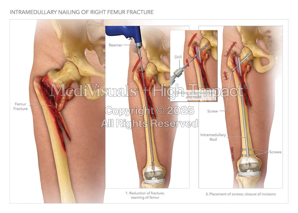 Intramedullary Nailing of Right Femur Fracture
