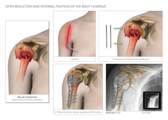 Open Reduction and Internal Fixation of the Right Humerus