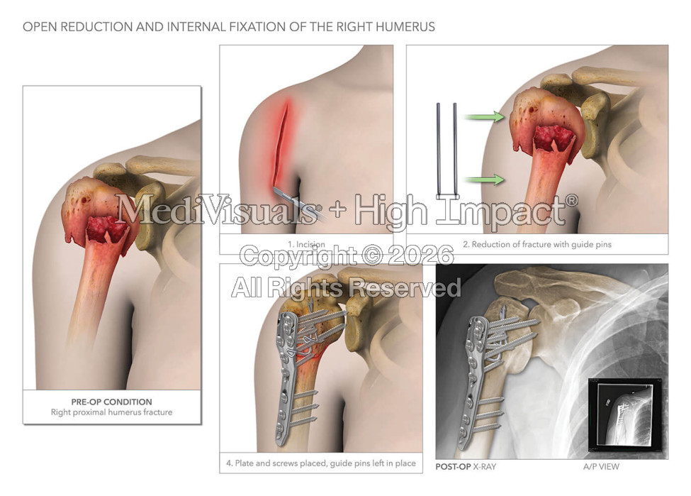 Open Reduction and Internal Fixation of the Right Humerus