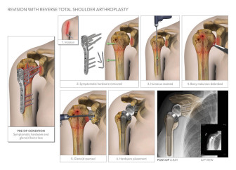 Revision with Reverse Total Shoulder Arthroplasty