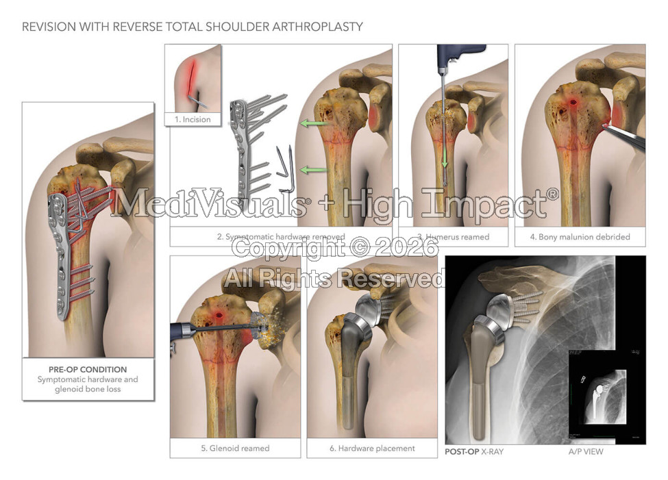 Revision with Reverse Total Shoulder Arthroplasty