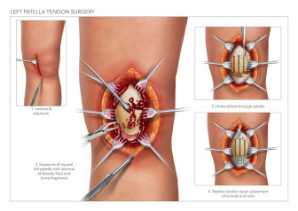 Left Patella Tendon Surgery