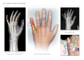 Left Hand Injury and Repair