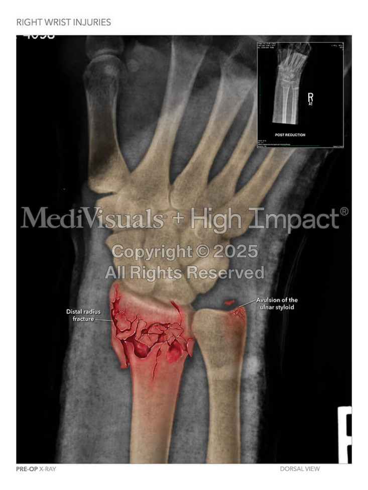 Right Wrist Injuries