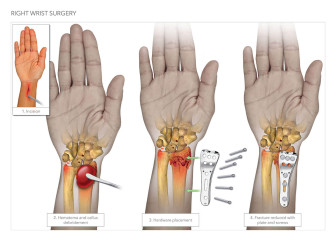 Right Wrist Surgery