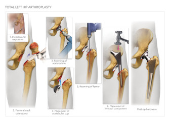 Left Total Hip Arthroplasty