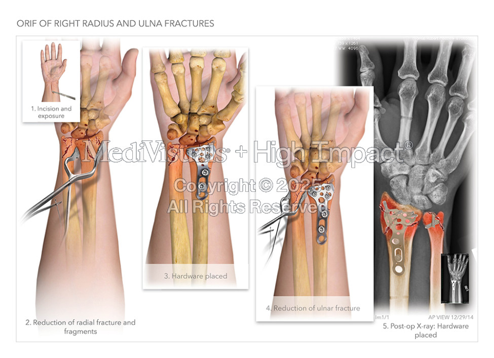 Open Reduction Internal Fixation of Radius and Ulna Fractures