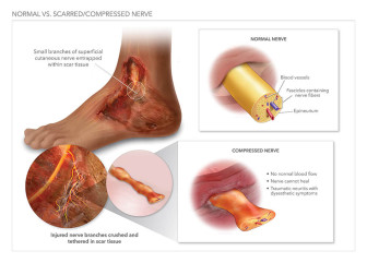 Normal Vs. Scarred & Compressed Nerve