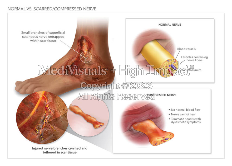 Normal Vs. Scarred & Compressed Nerve