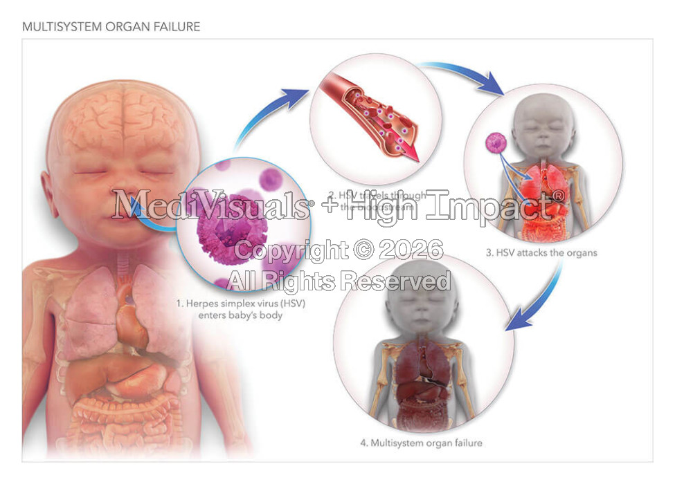 Multisystem Organ Failure