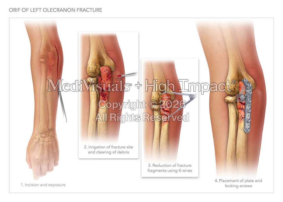 Elbow Injuries and Repair