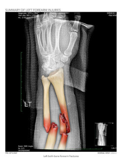 Summary of Left Forearm Injuries