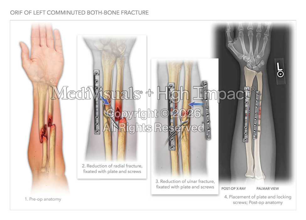 Forearm Injuries and Repair