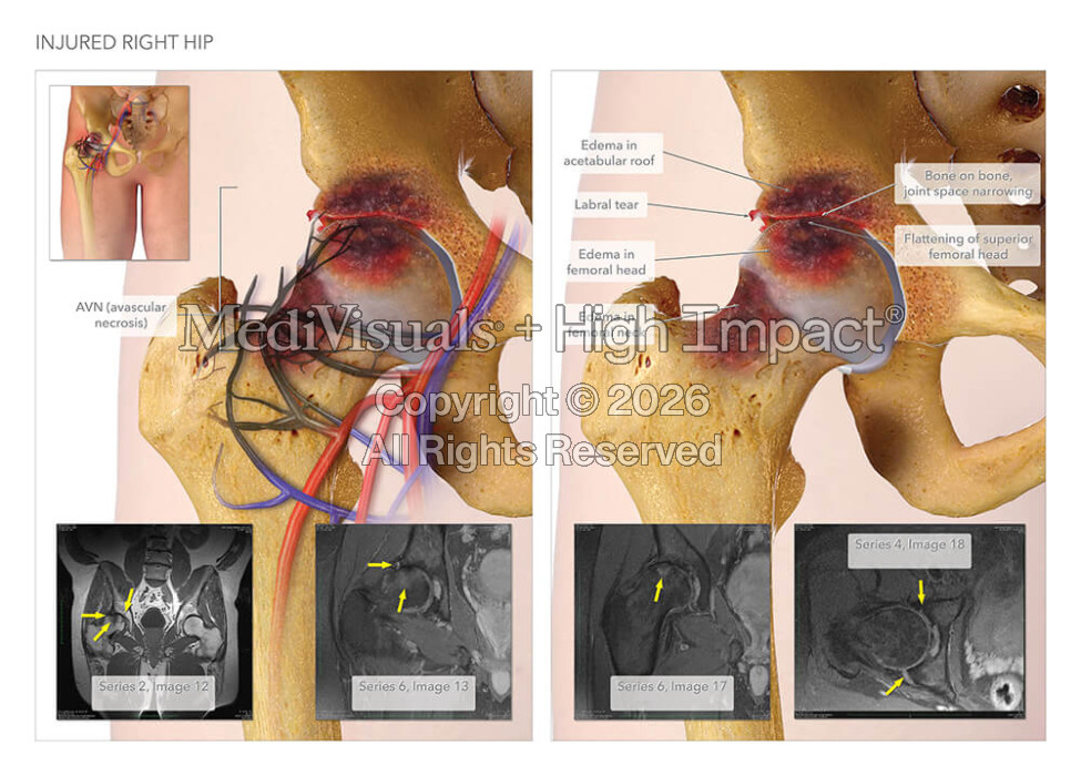 Injured Right Hip