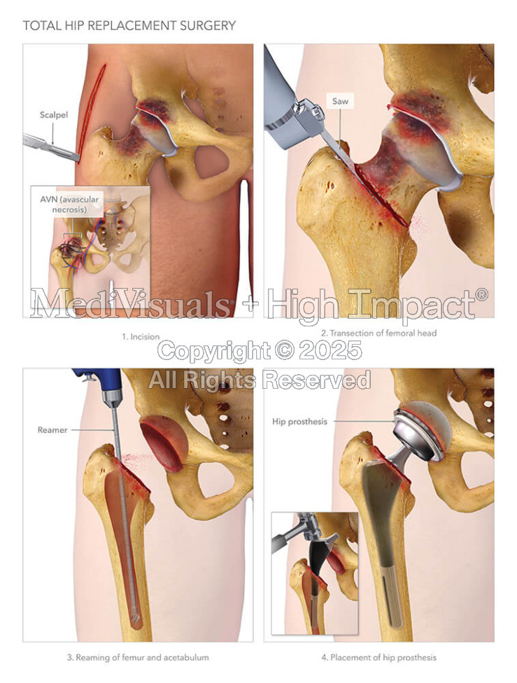 Total Hip Replacement Surgery