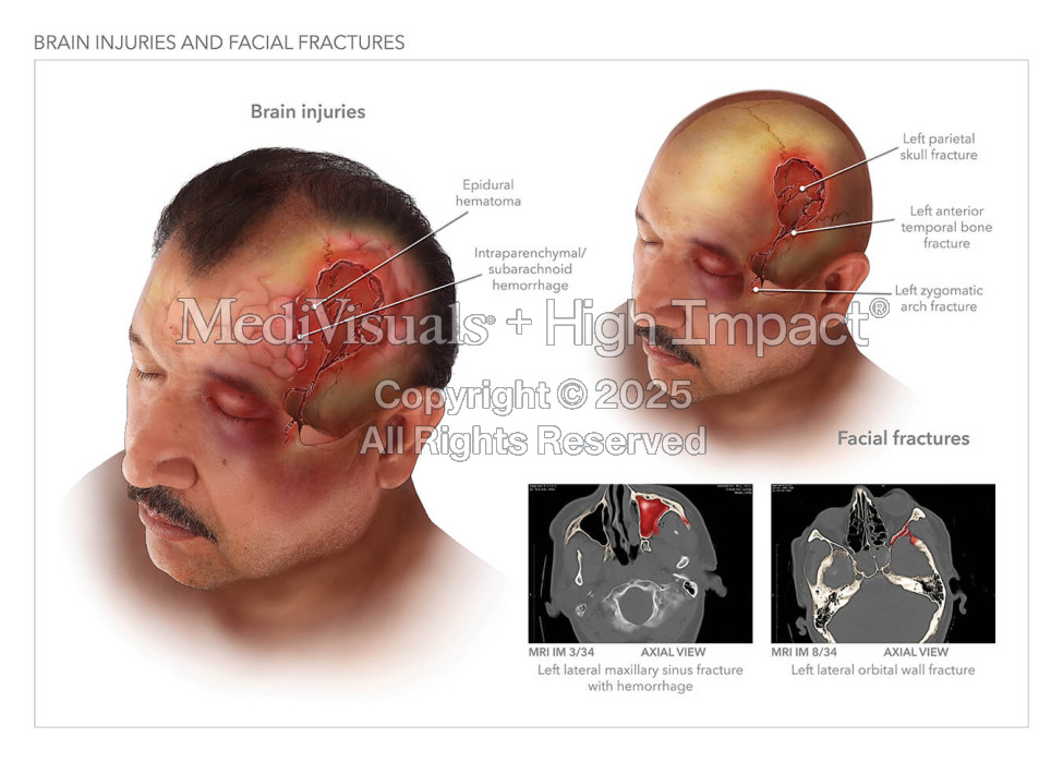 Brain Injuries and Facial Fractures