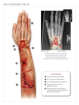 Right Hand and Wrist Pre-Op
