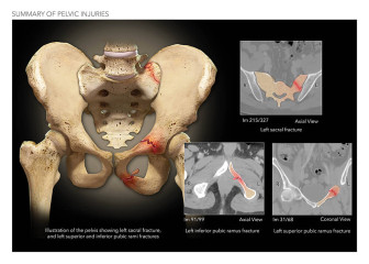 Summary of Pelvic Injuries